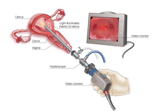 Hysteroscopic Surgery