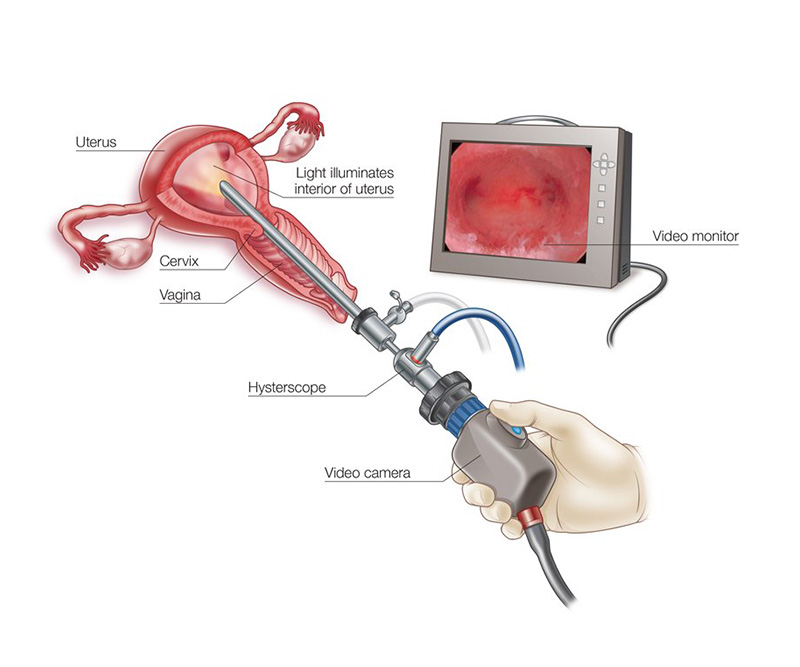 Hysteroscopic Surgery